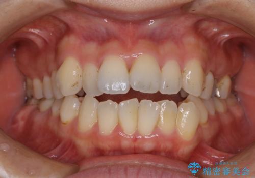 妊娠・出産後のPMTCの治療前