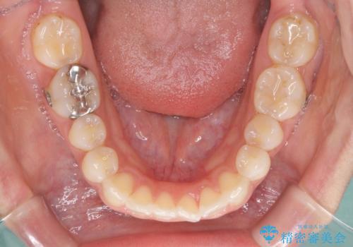 前歯の突出を軽減 インビザラインによる抜歯矯正の治療中