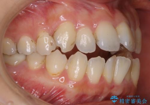 妊娠・出産後のPMTCの治療前