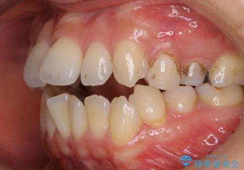 妊娠・出産後のPMTCの治療前