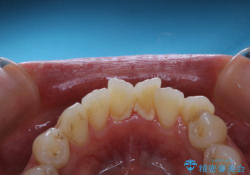 妊娠・出産後のPMTCの治療前