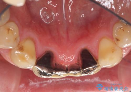 前歯の保険のブリッジ 欠けてしまったのをやり直したいの治療前