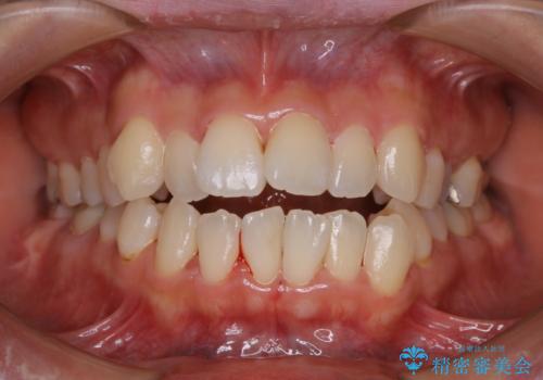 妊娠・出産後のPMTCの治療後