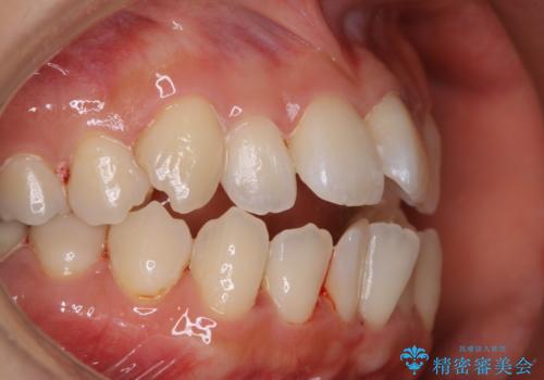 妊娠・出産後のPMTCの治療後