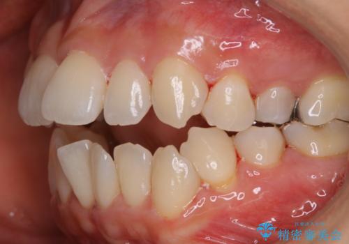 妊娠・出産後のPMTCの治療後