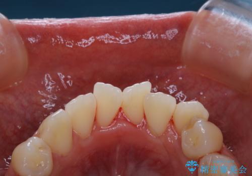 妊娠・出産後のPMTCの治療後