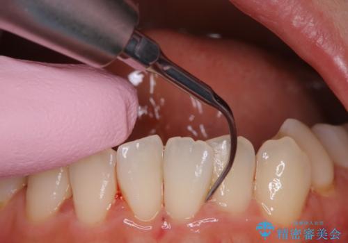 妊娠・出産後のPMTCの治療中