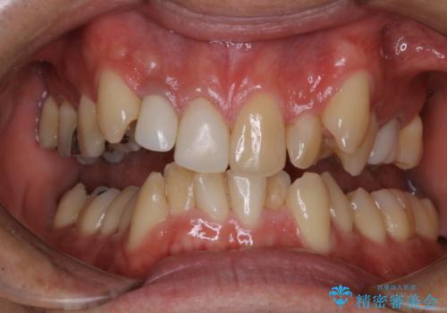 矯正治療前にホワイトニング の治療前