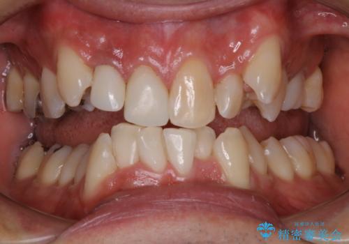 矯正治療前にホワイトニング の治療後