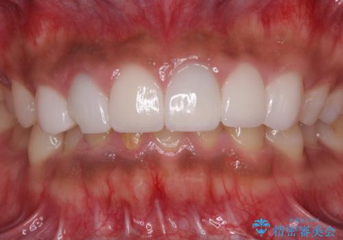 欠けてしまった前歯のセラミック 同じ色合いで再製作の治療前