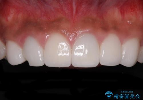 欠けてしまった前歯のセラミック　同じ色合いで再製作の症例 治療前