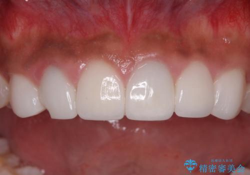 欠けてしまった前歯のセラミック　同じ色合いで再製作の治療前