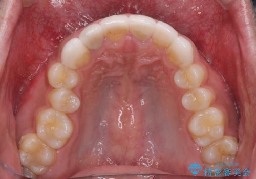 欠けてしまった前歯のセラミック 同じ色合いで再製作の治療前