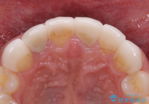 欠けてしまった前歯のセラミック 同じ色合いで再製作の治療前