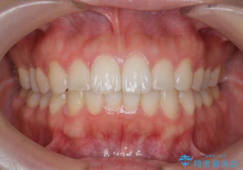 当医院で矯正治療後オフィスホワイトニング(エクセレント)でさらに口元を美しくの治療前