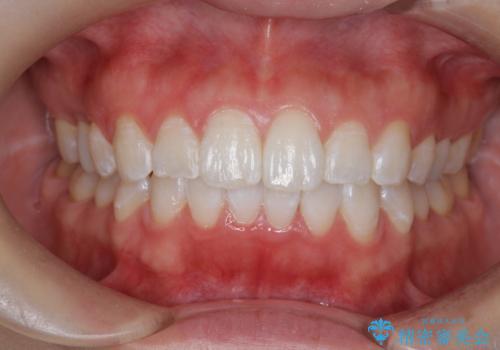 当医院で矯正治療後オフィスホワイトニング(エクセレント)でさらに口元を美しくの治療後