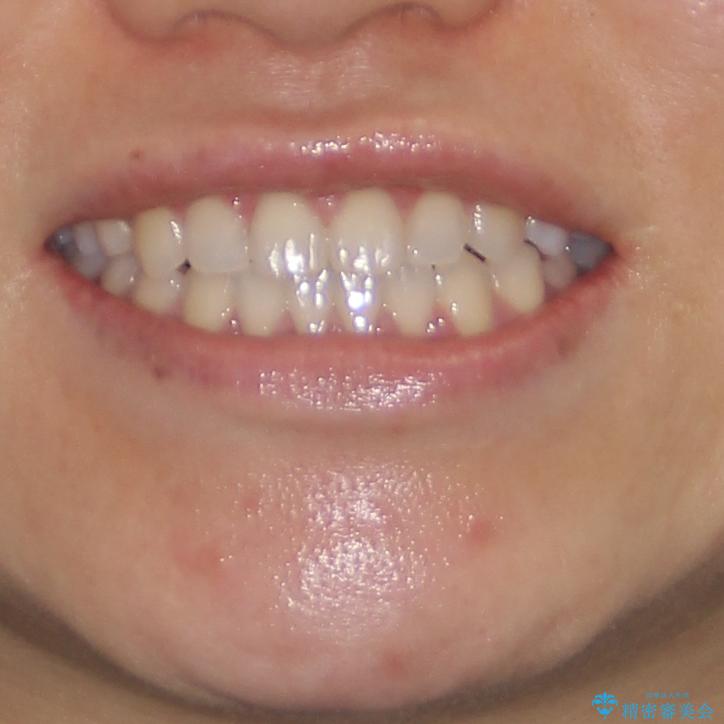 隙間の空いた前歯を治したい　インビザライン矯正治療の治療後（顔貌）