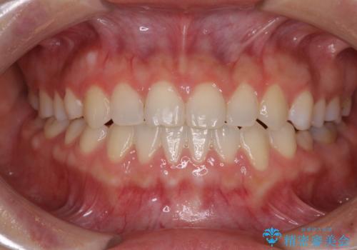 隙間の空いた前歯を治したい インビザライン矯正治療の治療後