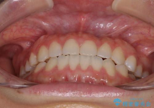 隙間の空いた前歯を治したい インビザライン矯正治療の治療後