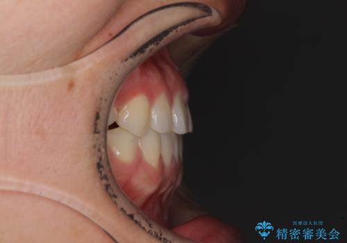 隙間の空いた前歯を治したい インビザライン矯正治療の治療後