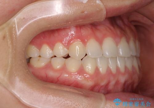 隙間の空いた前歯を治したい インビザライン矯正治療の治療後