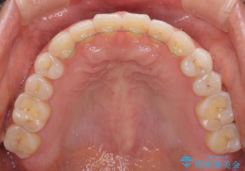 隙間の空いた前歯を治したい インビザライン矯正治療の治療後