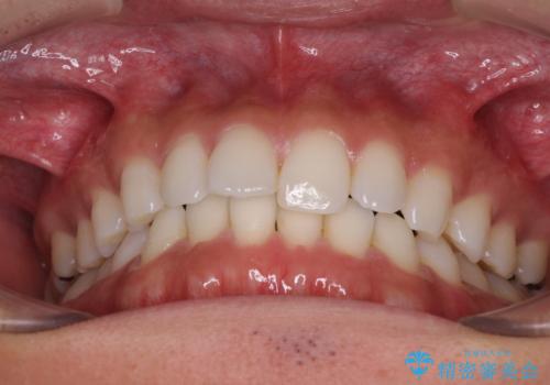 気になる後戻り 前歯をインビザライン・ライトで改善の治療前