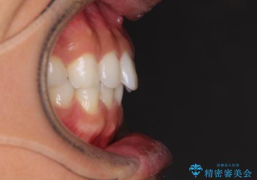 気になる後戻り 前歯をインビザライン・ライトで改善の治療前