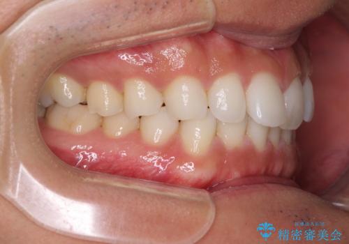 気になる後戻り 前歯をインビザライン・ライトで改善の治療前