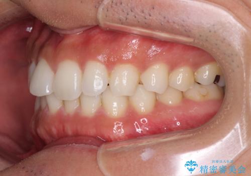 気になる後戻り 前歯をインビザライン・ライトで改善の治療前