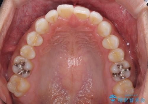 気になる後戻り 前歯をインビザライン・ライトで改善の治療前