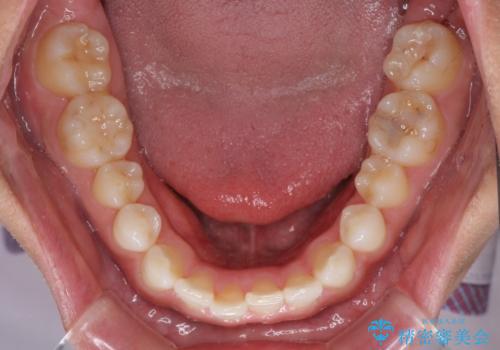 気になる後戻り 前歯をインビザライン・ライトで改善の治療前