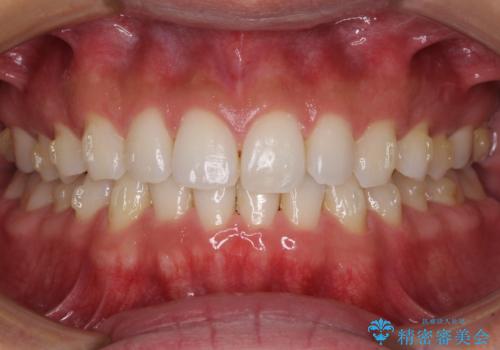 気になる後戻り 前歯をインビザライン・ライトで改善の治療中