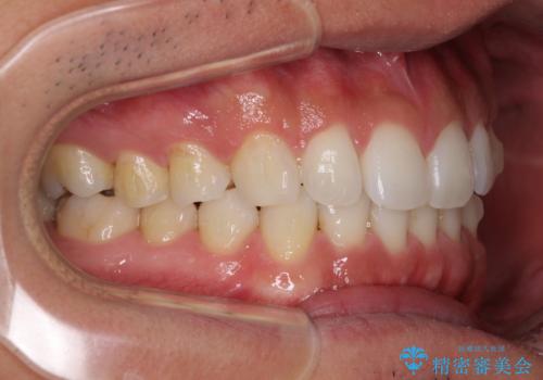 気になる後戻り 前歯をインビザライン・ライトで改善の治療中