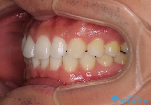 気になる後戻り 前歯をインビザライン・ライトで改善の治療中