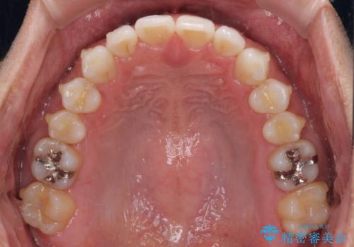 気になる後戻り 前歯をインビザライン・ライトで改善の治療中