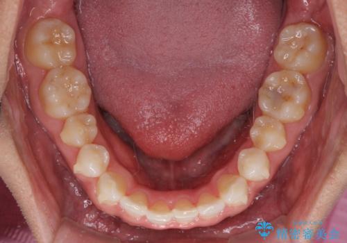 気になる後戻り 前歯をインビザライン・ライトで改善の治療中