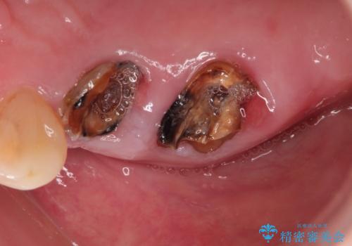 奥歯がなくなり咬めない インプラント治療による咬み合わせの回復の治療前