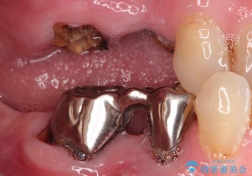 奥歯がなくなり咬めない インプラント治療による咬み合わせの回復の治療前