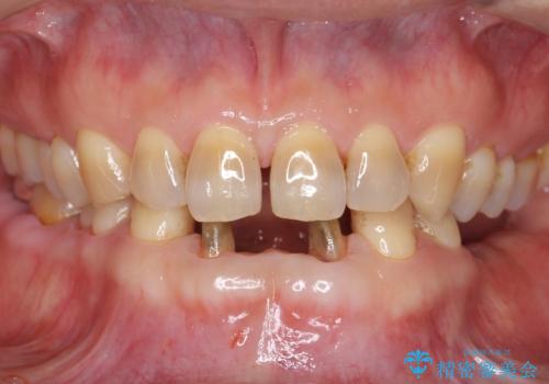 前歯の保険のブリッジ 欠けてしまったのをやり直したいの治療中