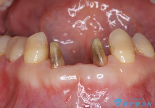 前歯の保険のブリッジ 欠けてしまったのをやり直したいの治療中