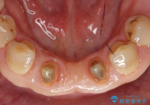 前歯の保険のブリッジ 欠けてしまったのをやり直したいの治療中