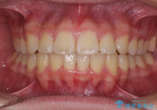 前歯のデコボコを短期間で治療　目立たないワイヤー矯正