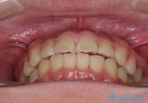 前歯のデコボコを短期間で治療 目立たないワイヤー矯正の治療後