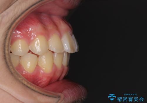 前歯のデコボコを短期間で治療 目立たないワイヤー矯正の治療後