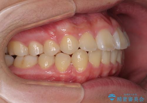前歯のデコボコを短期間で治療 目立たないワイヤー矯正の治療後
