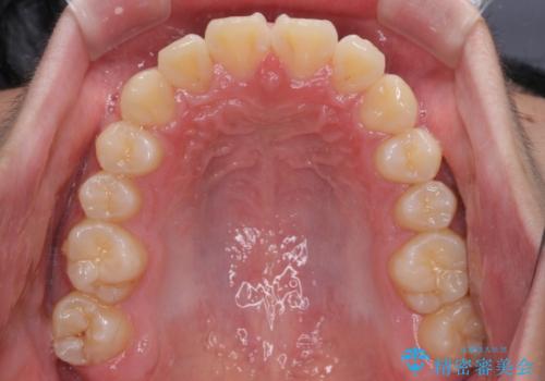 前歯のデコボコを短期間で治療 目立たないワイヤー矯正の治療後