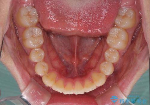 前歯のデコボコを短期間で治療　目立たないワイヤー矯正の治療後
