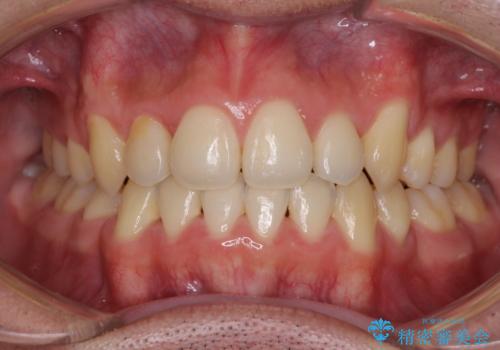 八重歯を治したい 目立たないワイヤー装置での抜歯矯正の症例 治療後