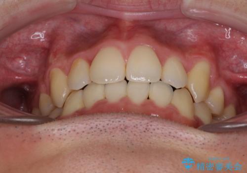 八重歯を治したい 目立たないワイヤー装置での抜歯矯正の治療後